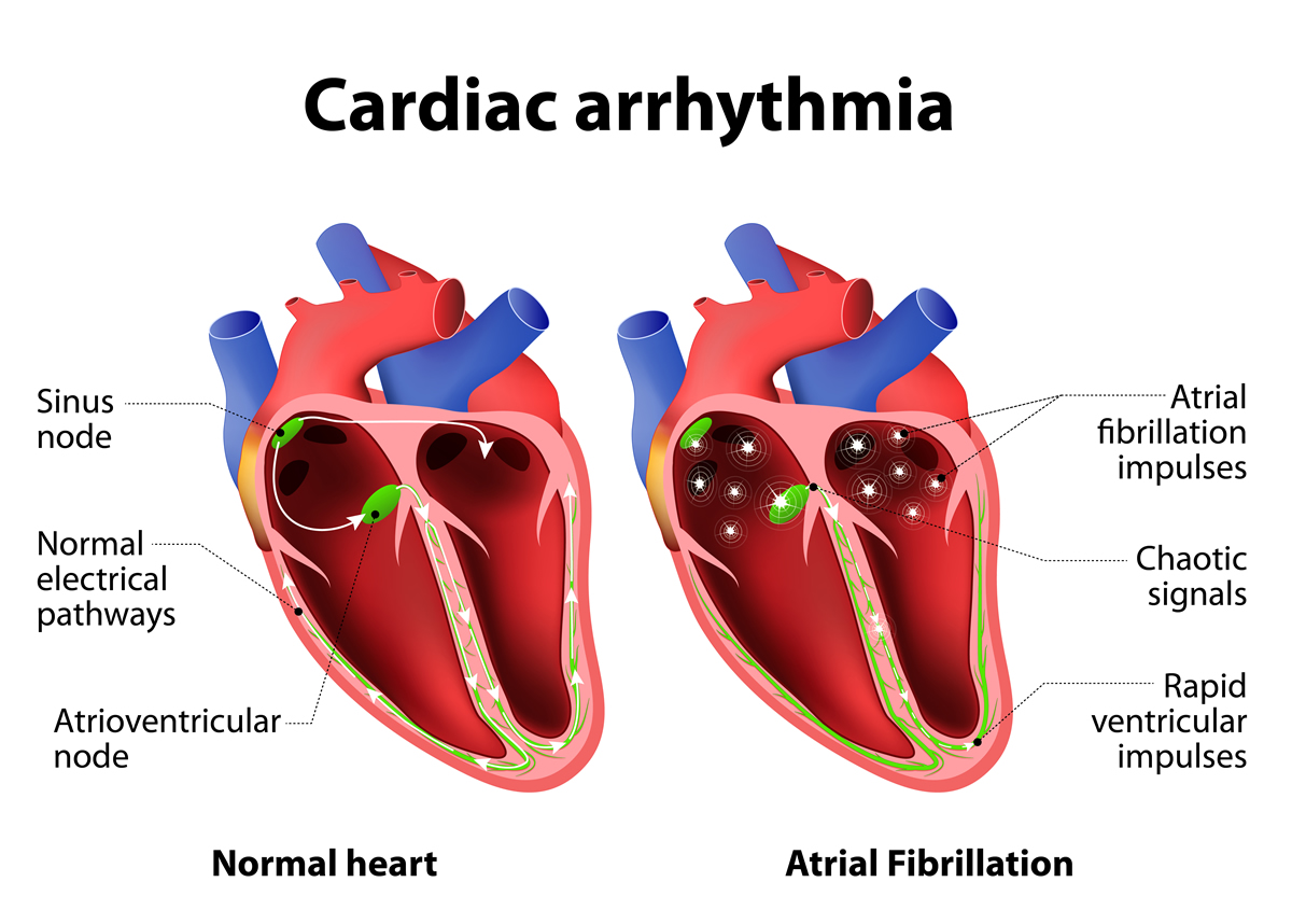 heart Arrhythmia